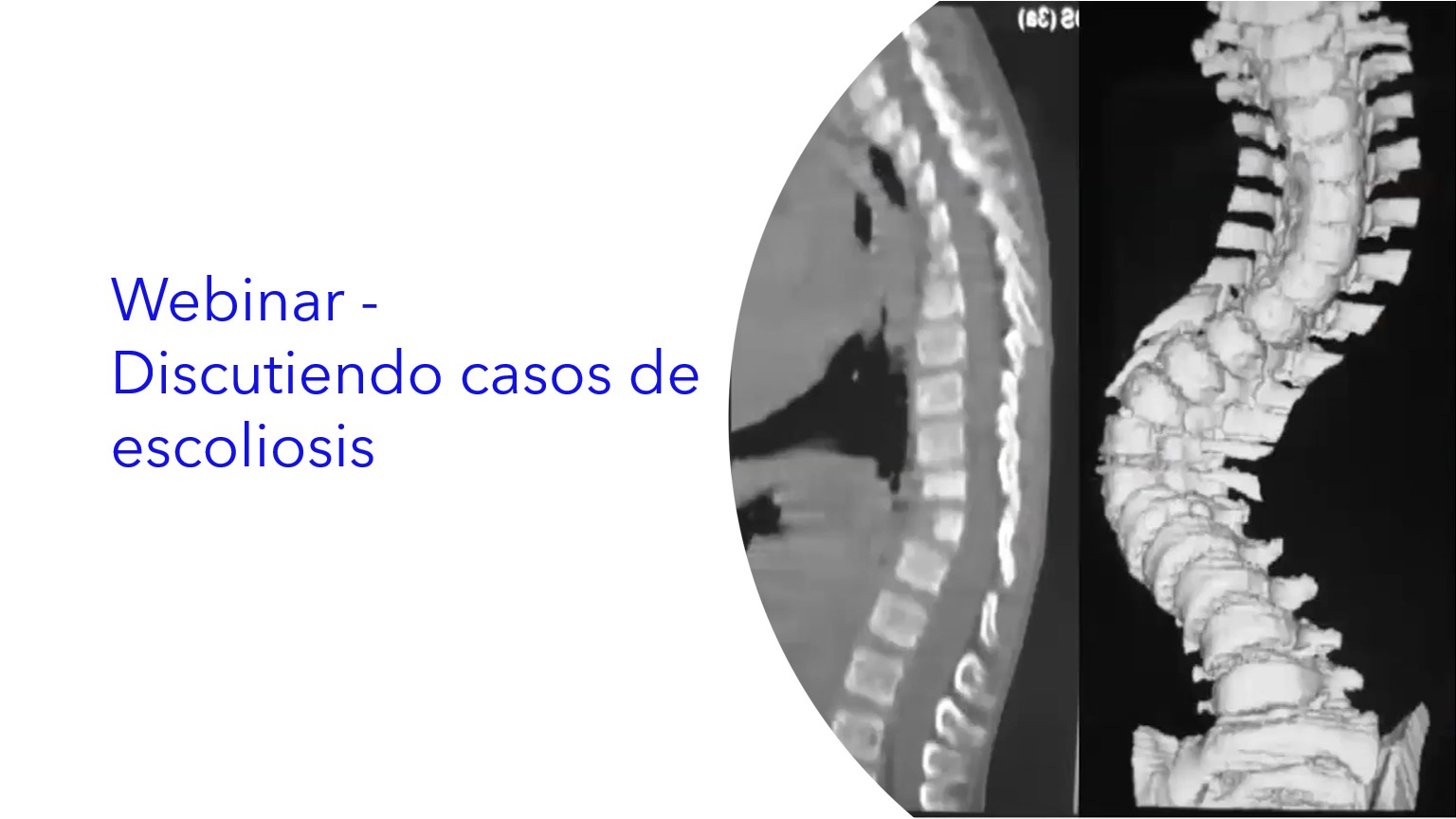 Webinar - Discutiendo Casos de Escoliosis.|Webinar - Discutindo Casos de Escoliose.|Webinar - Discussing Scoliosis Cases.