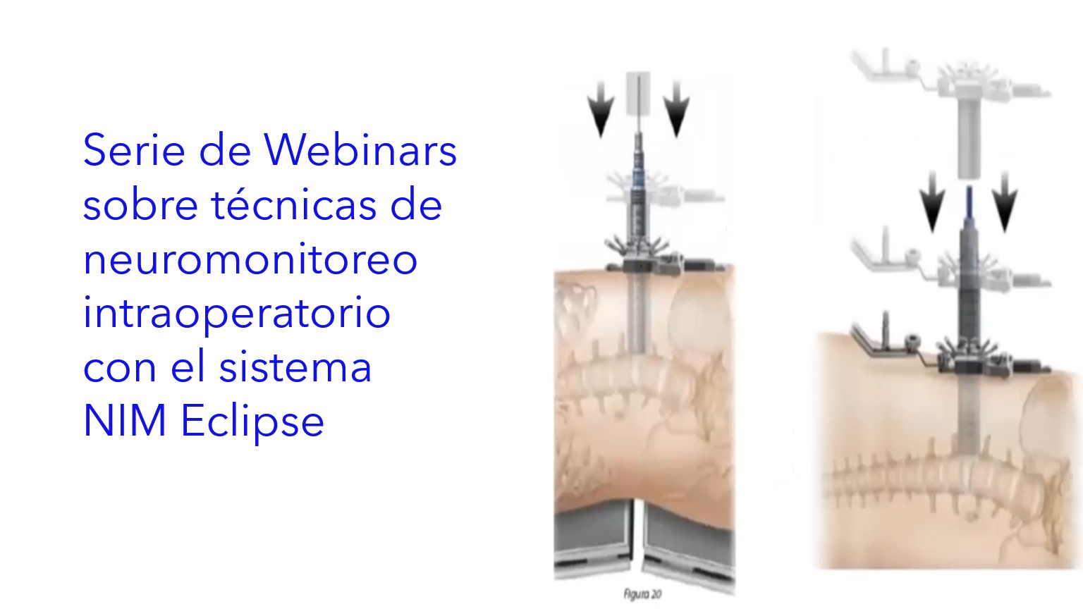 Serie de Webinars sobre Técnicas de Neuromonitoreo Intraoperatorio con el sistema NIM Eclipse.| Série de webinars sobre técnicas de neuromonitoramento intraoperatório com o sistema NIM Eclipse.