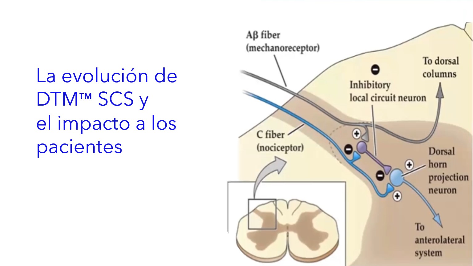 La evolución de DTM™ SCS y el impacto a los pacientes