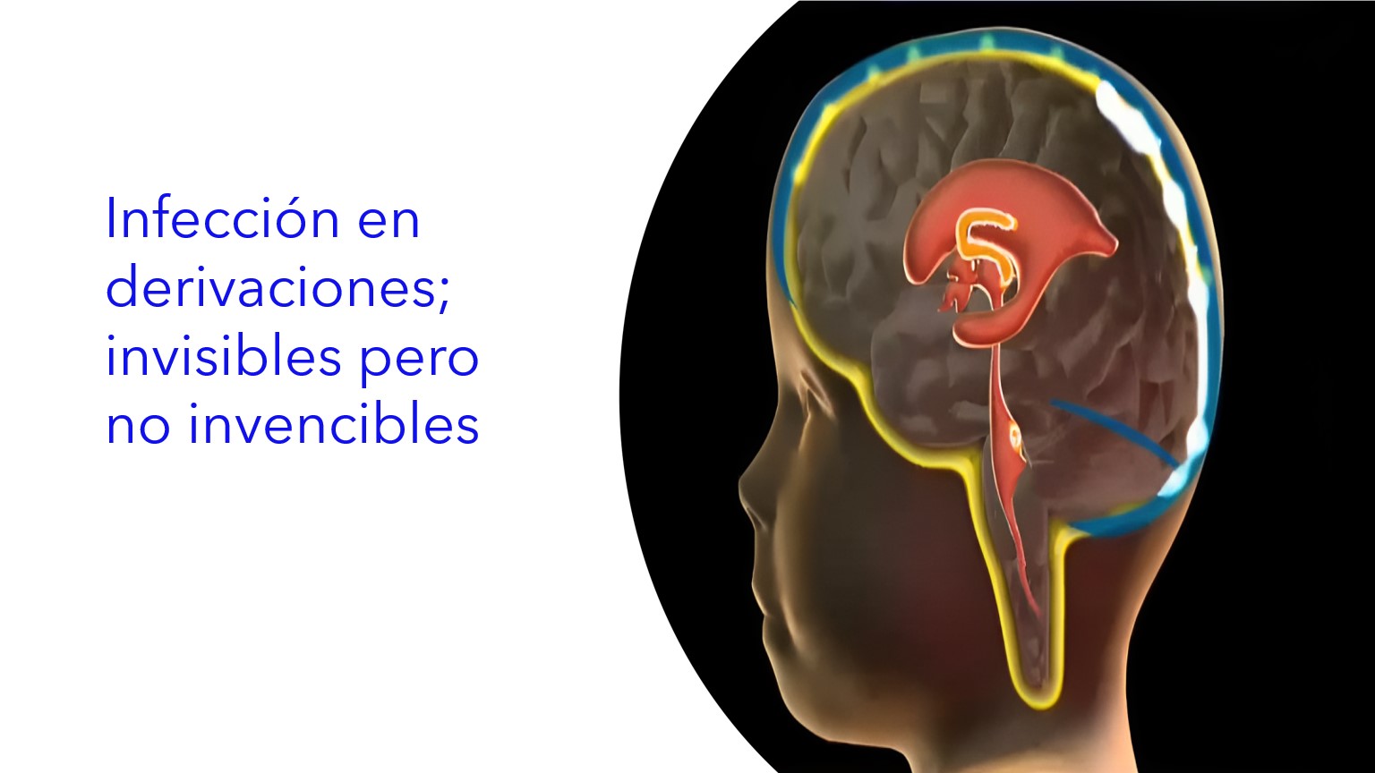 Infección en derivaciones; invisibles pero no invencibles