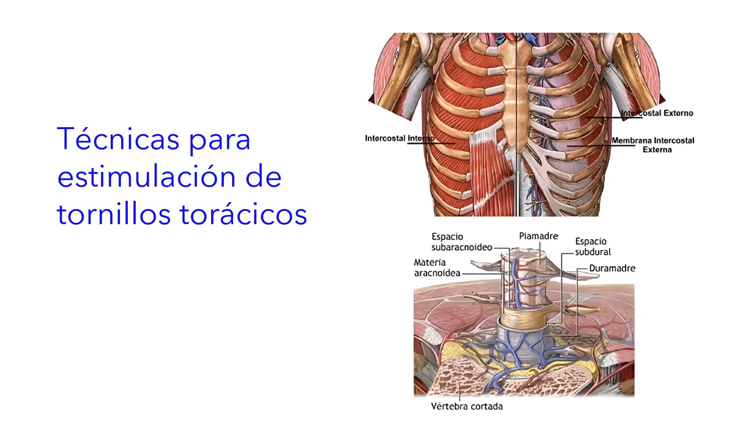 Técnicas para Estimulación de Tornillos Torácicos . | Técnicas para Estimulação de Parafusos Torácicos . | Techniques for Stimulation of Thoracic Screws