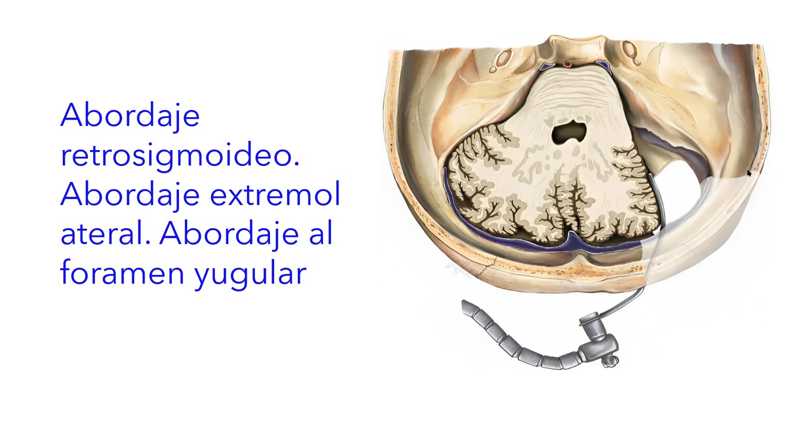 Abordaje al Foramen Yugular